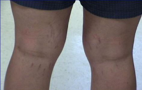 Bartonella tracks on leg